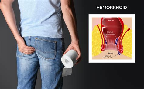 How To Avoid Hemorrhoid Flare Ups