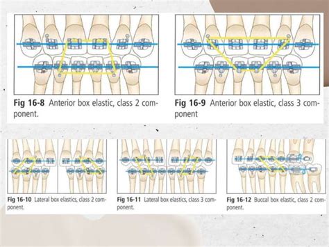 Intraoral Elastics In Orthodontics Pptx Free Download