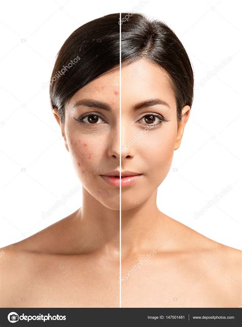 Cara De Mulher Antes E Depois Do Procedimento De Tratamento Da Acne