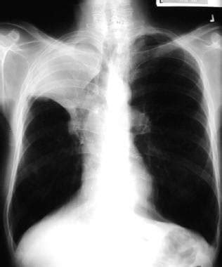 Atelectasis Chest X Ray