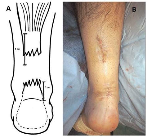 Rupture Du Tendon D Achille