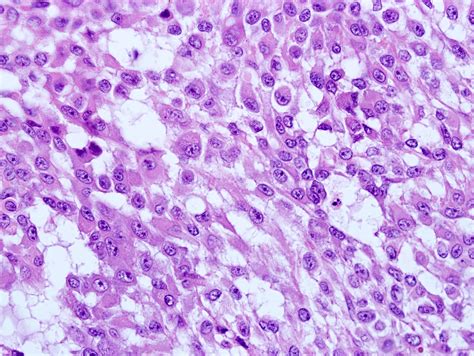 Pathology Outlines Myoepithelioma Myoepithelial Carcinoma Mixed Tumor