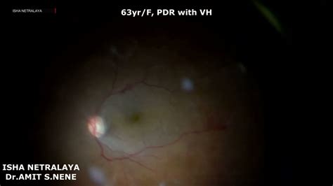 Vitrectomy For Vitreous Hemorrhage Youtube