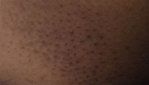 What is this in my inner thigh : r/DermatologyQuestions