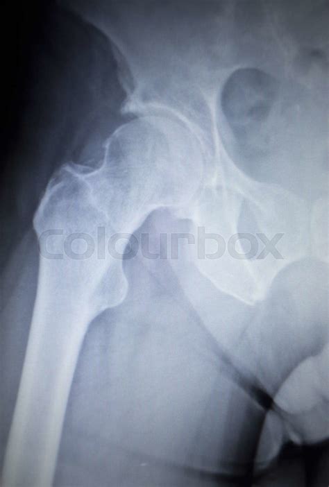 X Ray Scan Image Of Hip Joint Replacement Orthopedic Implant Stock