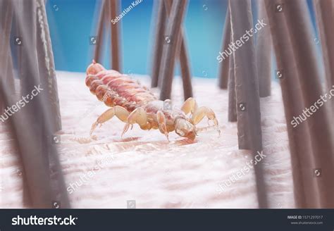 Lice infestation Images, Stock Photos & Vectors | Shutterstock