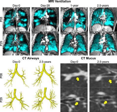 Ct Mucus Score And 129xe Mri Ventilation Defects After 25 Years Anti