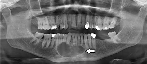 Ameloblastoma Of The Mandible Analysis Of Radiographic And