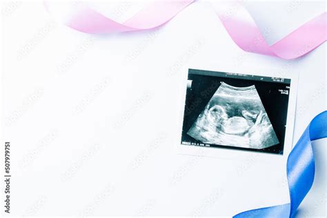 Ultrasound photo pregnancy baby. Blue, pink ribbon with ultrasound pregnancy picture on white ...