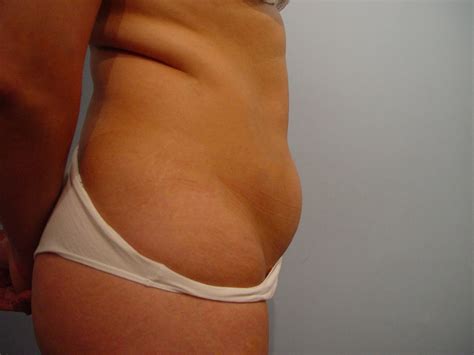 Liposuzione Liposcultura Chirurgia Estetica Pisa Dott Cecchini