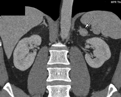 Adrenal Imaging With Multidetector Ct Evidence Based Protocol Optimization And Interpretative