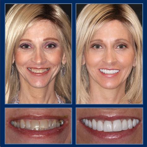 At The Cosmetic Dentists Of Austin We Perform Amazing Smile Makeovers