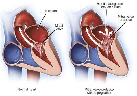 Mitral Valve Prolapse Causes Symptoms Diagnosis Treatment