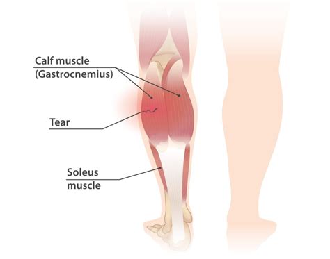 Calf Strain - Range Physiotherapy