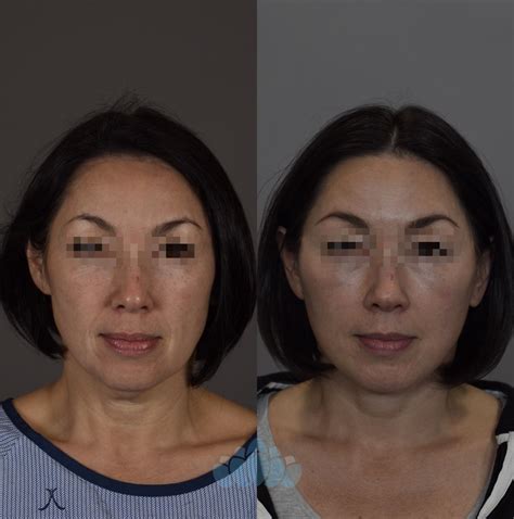 Facelift Before And After Pictures Case 93 Charlotte Nc Dilworth Facial Plastic Surgery