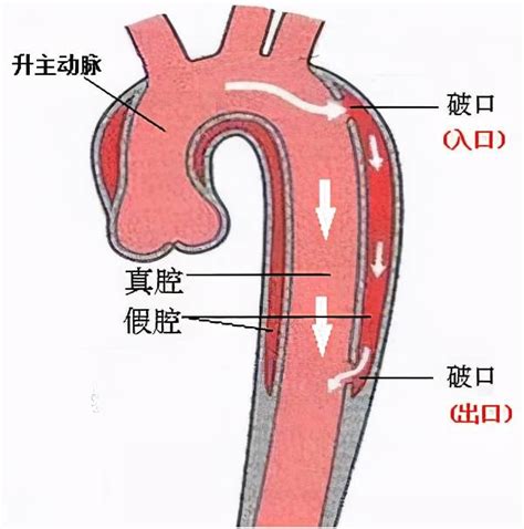 科普 “人体炸弹”之主动脉夹层 豫健科普 漯河市中心医院