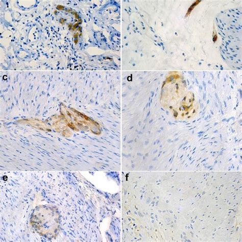 Immunohistochemical Expression Of Bcl 2 Strong Bcl 2 Positivity Of 6