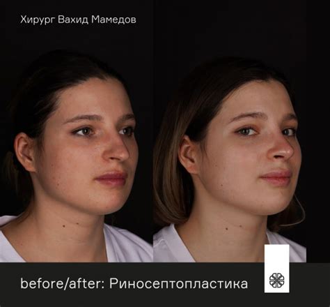 Омолаживающая ринопластика