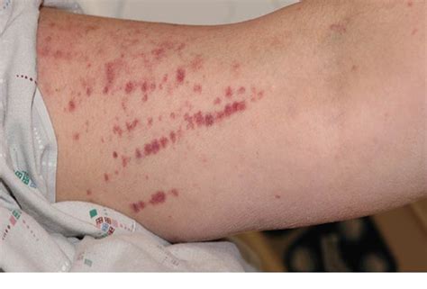 Where Do You Find Pictures To Help Diagnose A Rash On Arms And Shoulders Proquestyamahaweb