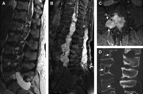 Intradural Extramedullary Tumors And Associated Syndromes