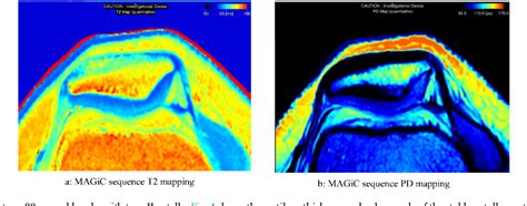 Difference In Quantitative Mri Measurements Of Cartilage Between Wiberg