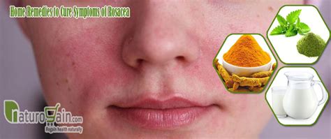 9 Best Home Remedies For Rosacea That Give Fast Relief