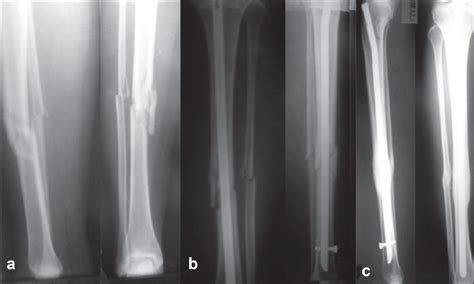 A X Ray Of Right Leg Lateral And Anteroposterior Views Showing A