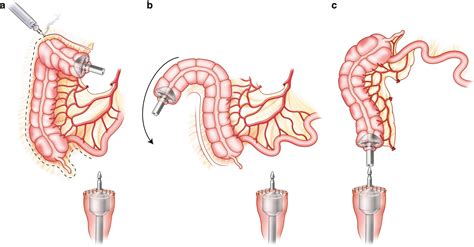 Anastomotic Construction SpringerLink