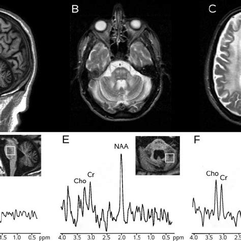 Mr Imaging And H Mr Spectroscopy In A Patient With Fxtas Case