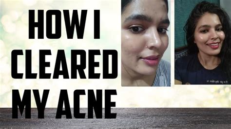 How I Cleared My Skin Mene Apne Pimple Ko Clear Kaise Kia My Acne