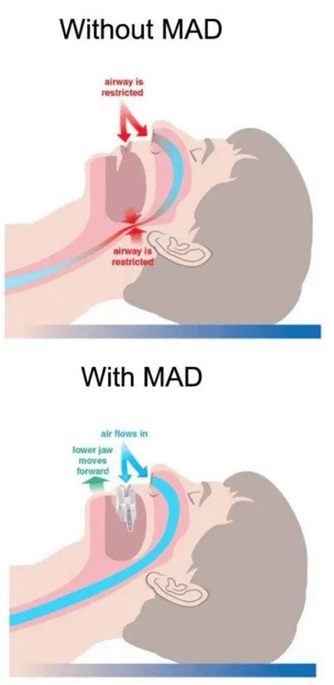 Sleep Apnea And Snoring Dentist South San Francisco Dentist