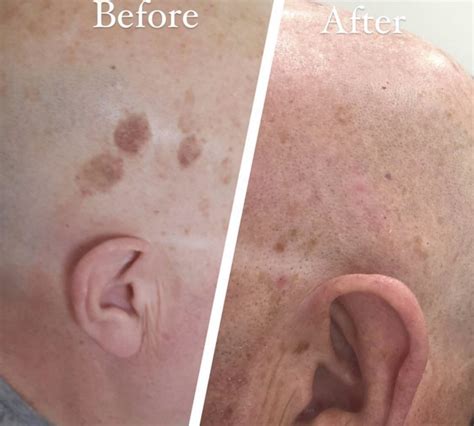 Laser Mole Removal Plasma Pen Mole Removal Treatment In Bolton