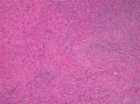 Chronic Intermittent Partial Torsion Of A Benign Ovarian Fibroma