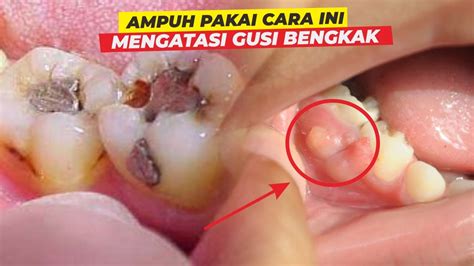 Cara Mengatasi Agar Gigi Berlubang Tidak Sakit