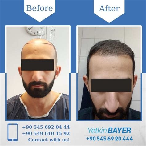 Hair Transplant Turkey Before After Dr Yetkin Bayer Clinics