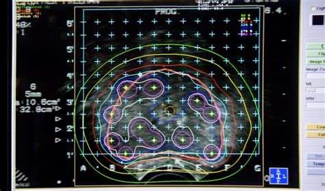 Low-Dose Brachytherapy Improves Disease-Free Survival in Unfavorable-Risk Prostate Cancer ...