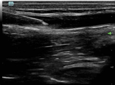 Tips And Tricks Best Practices For Ultrasound Guided Iv Placement Em Ultrasound Section