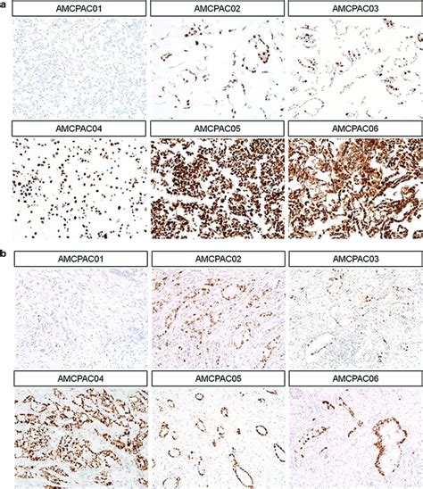 Representative P53 Immunohistochemical Staining A P53 Expression In