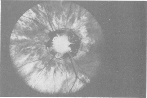 Coloboma Of The Optic Disc Download High Quality Scientific Diagram