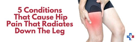 Injuries That Cause Hip Pain That Radiates Down The Leg Primary