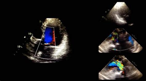 Echocardiography Ultrasound Examination Heart Stock Footage Video (100% ...