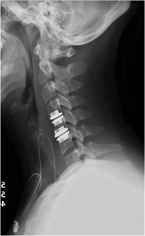 Cervical Disc Arthroplasty A Comprehensive Review Of Single Level