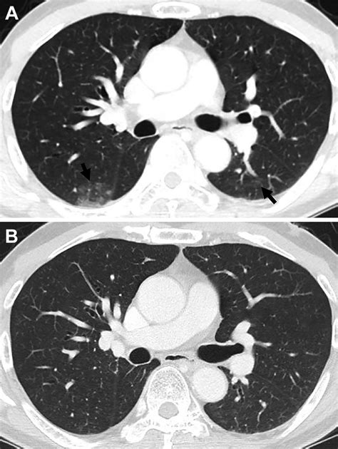 Images Show Osimertinib Related Pneumonitis With Simple Pulmonary