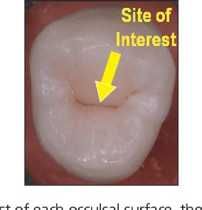 Table 2 From In Vitro Quantification Of Occlusal Caries Lesion Using