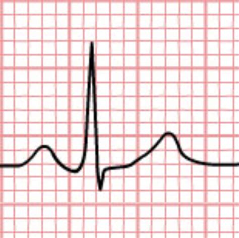 Basic Dysrhythmias Ekg Intro Atria Flashcards Quizlet