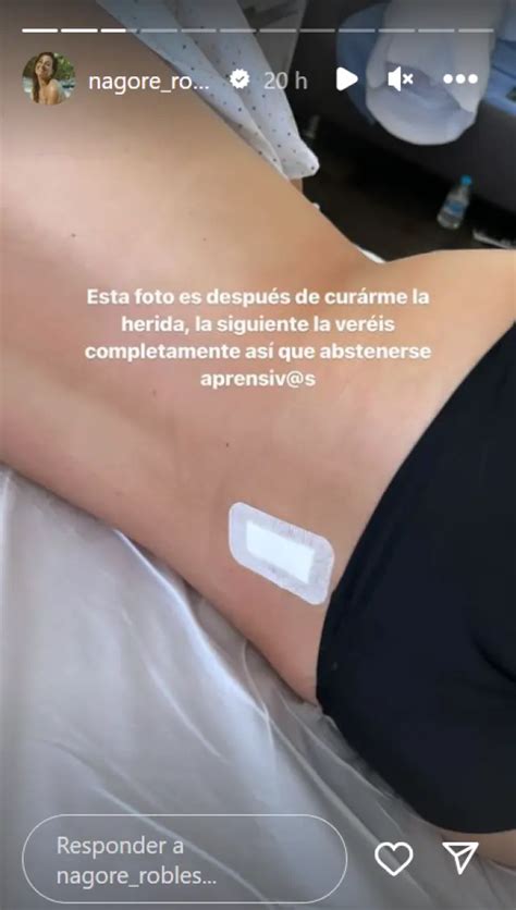 Nagore Robles muestra la cicatriz de su espalda tras su operación