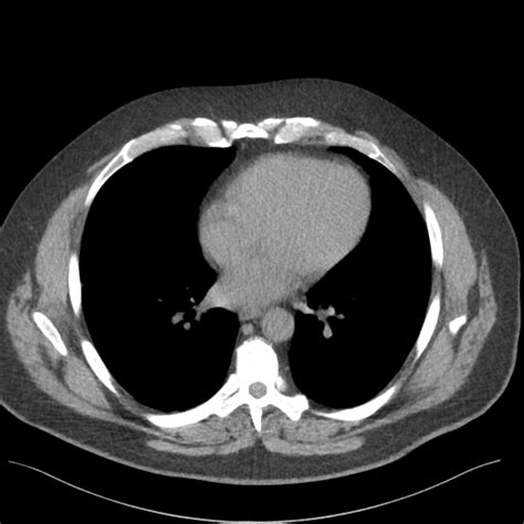 Normal Hrct Image