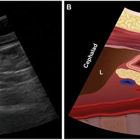 A Sagittal Sonography Of The Gastric Antrum A Antrum L Liver Download Scientific Diagram