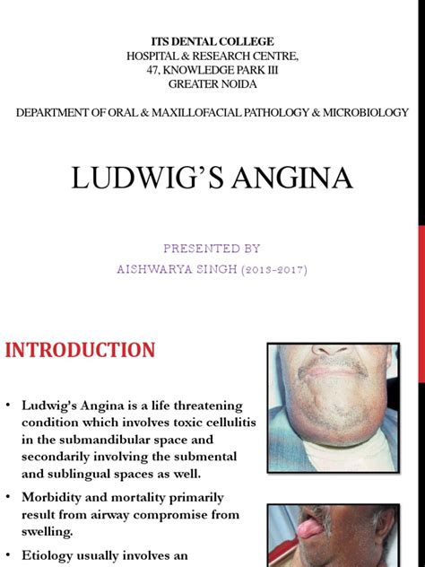 Ludwigs Angina Medical Specialties Clinical Medicine