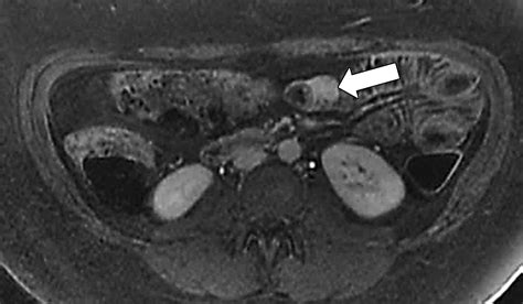 Atypical Sites Of Deeply Infiltrative Endometriosis Clinical Characteristics And Imaging